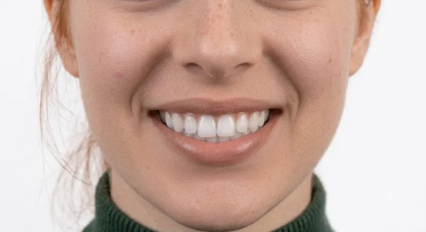 Zahnbleaching nachher – Patient 2