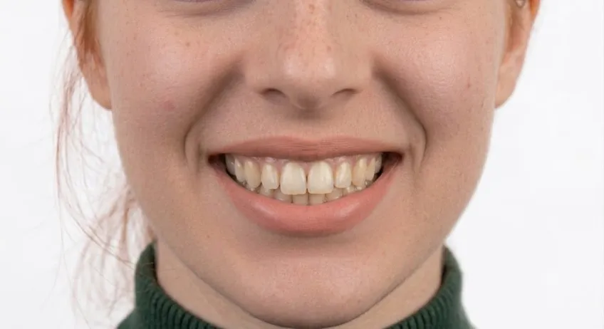 Zahnbleaching vorher – Patient 2