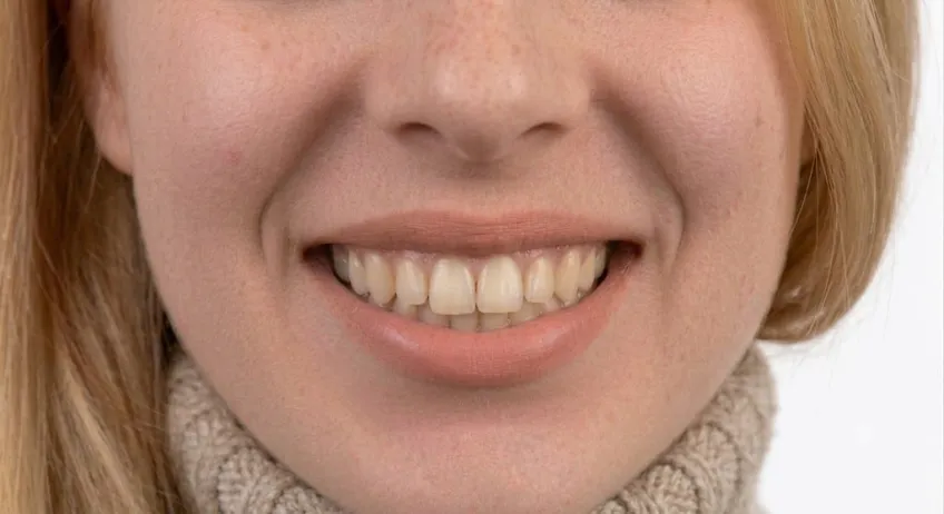 Zahnbleaching vorher – Patient 1