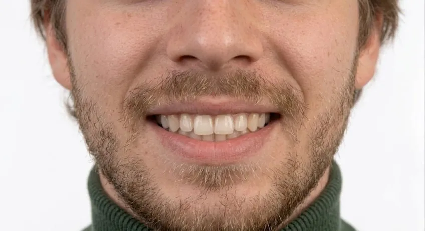 Zahnbleaching vorher – Patient 3